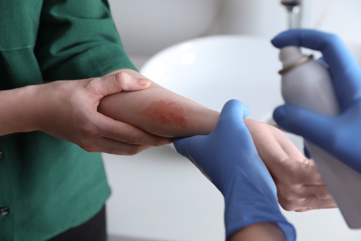 How To Prevent Scarring After a Burn Injury