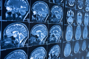 How Elrod Pope Accident & Injury Attorneys Can Help After a Brain Injury in Charlotte, NC