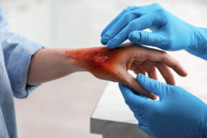 Doctor treating burn injury patient.